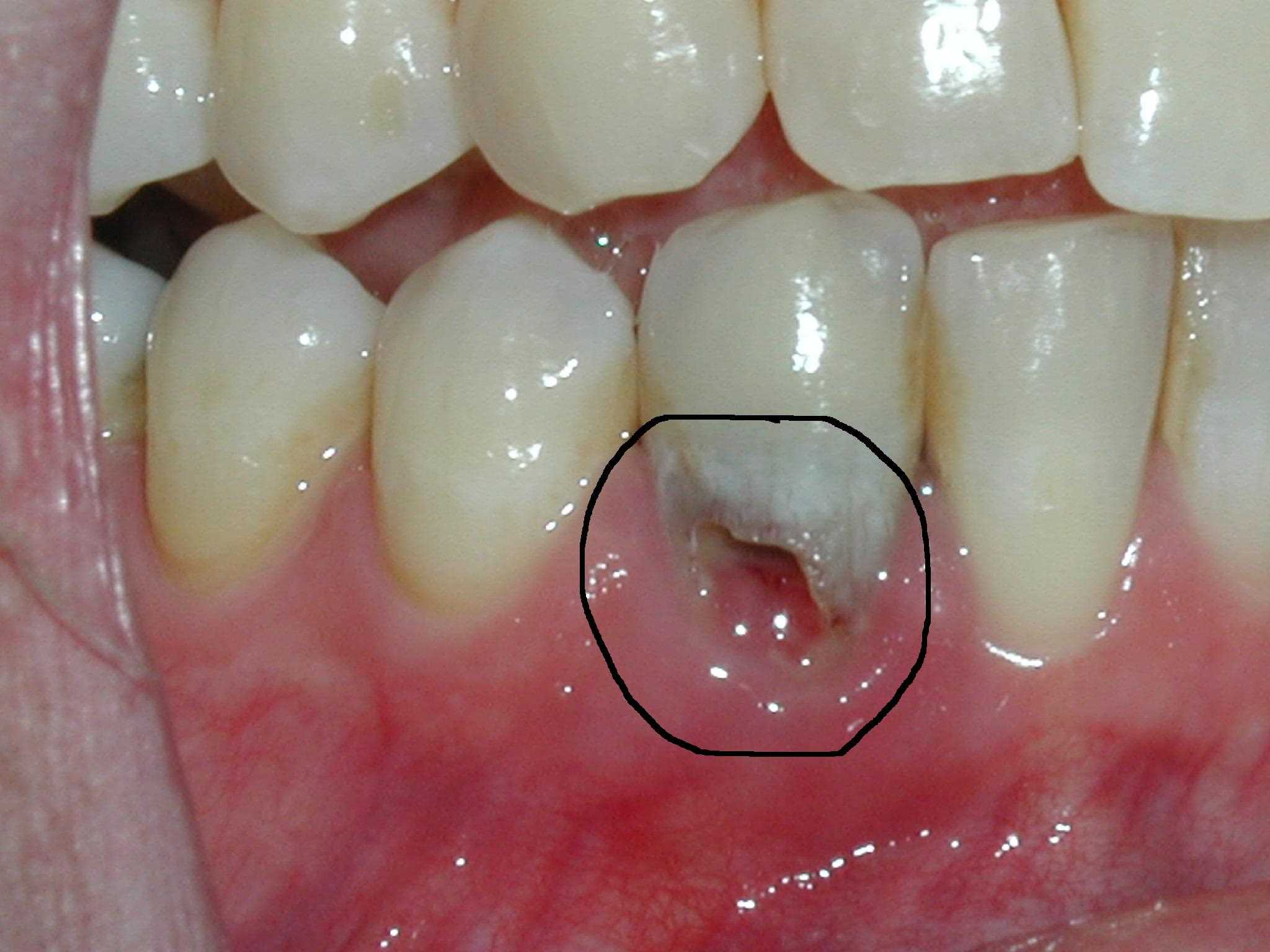 external resorption of tooth